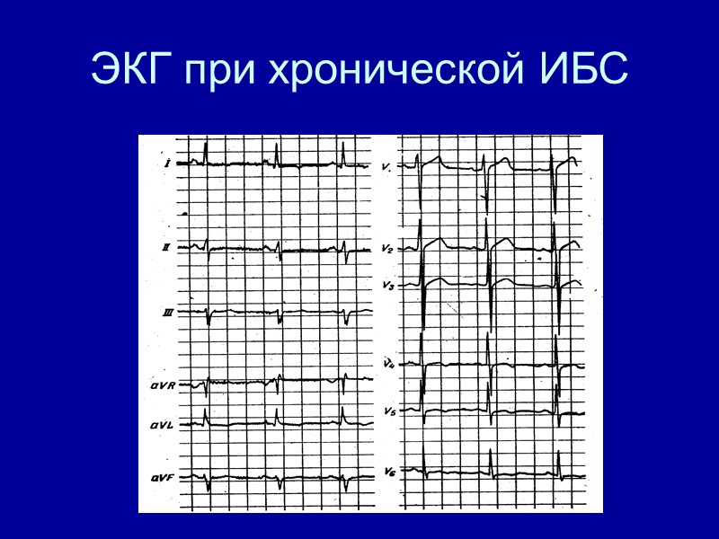 ЭКГ при хронической ИБС